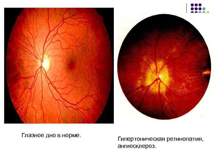 Гипертоническая ангиопатия презентация