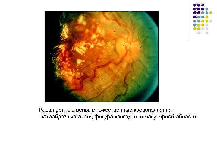 Расширенные вены, множественные кровоизлияния, ватообразные очаги, фигура «звезды» в макулярной области. 