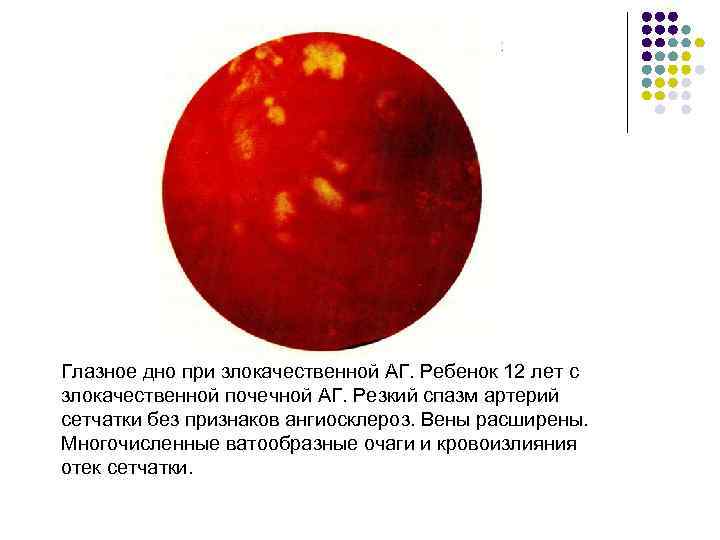 Глазное дно при злокачественной АГ. Ребенок 12 лет с злокачественной почечной АГ. Резкий спазм