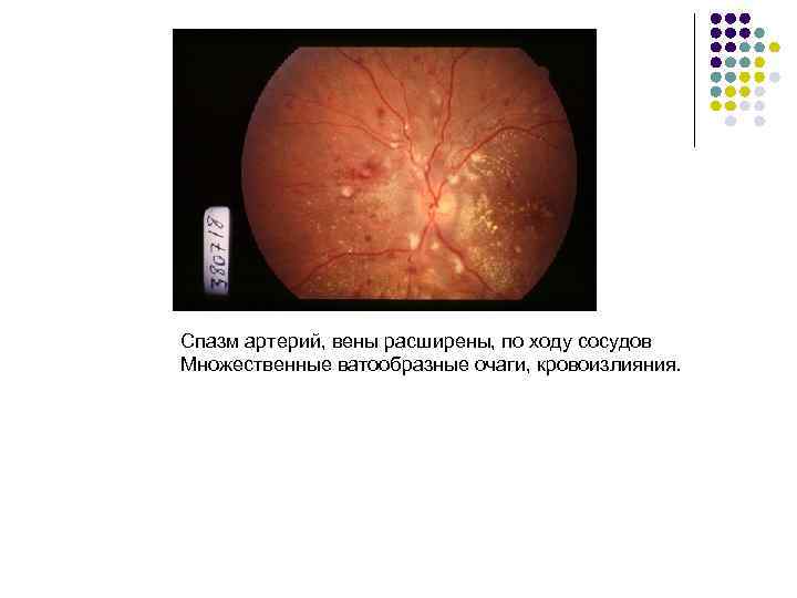 Спазм артерий, вены расширены, по ходу сосудов Множественные ватообразные очаги, кровоизлияния. 
