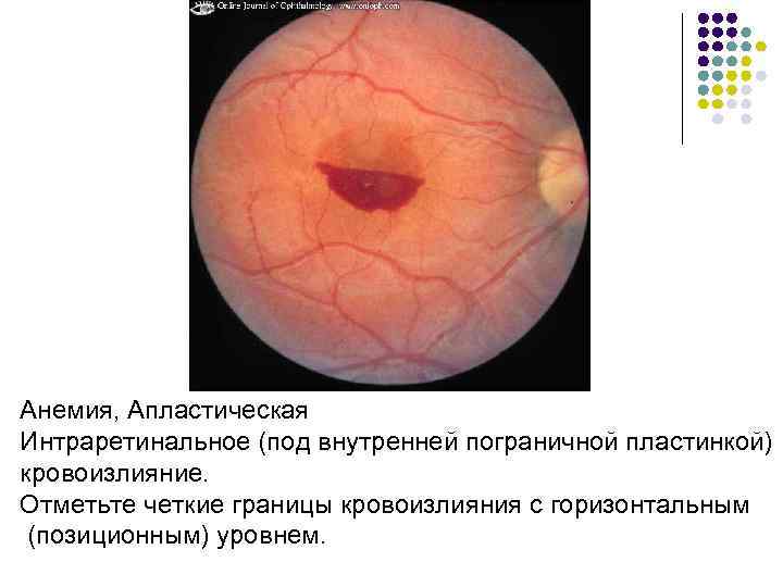Анемия, Апластическая Интраретинальное (под внутренней пограничной пластинкой) кровоизлияние. Отметьте четкие границы кровоизлияния с горизонтальным