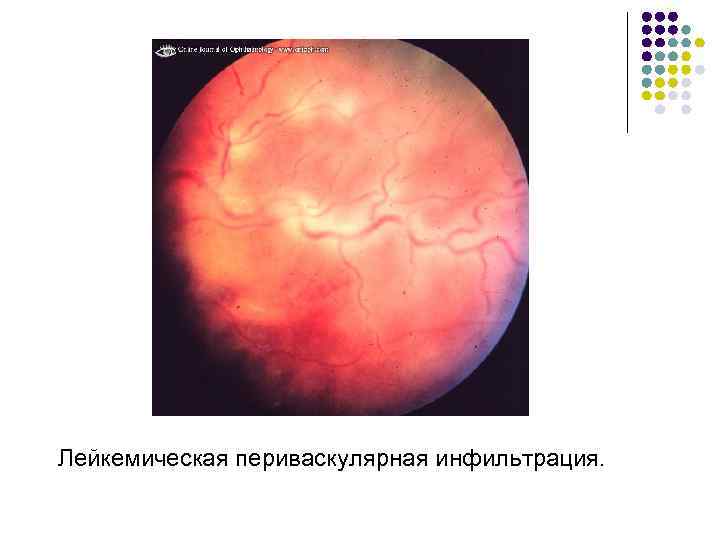 Лейкемическая периваскулярная инфильтрация. 