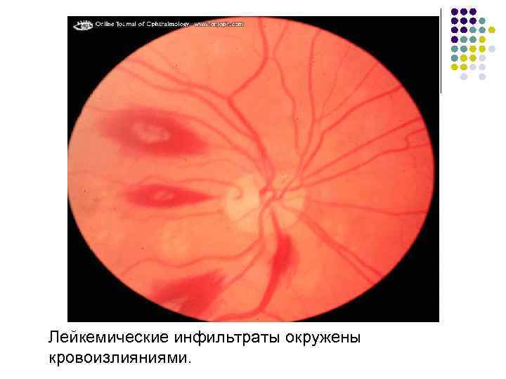 Лейкемические инфильтраты окружены кровоизлияниями. 
