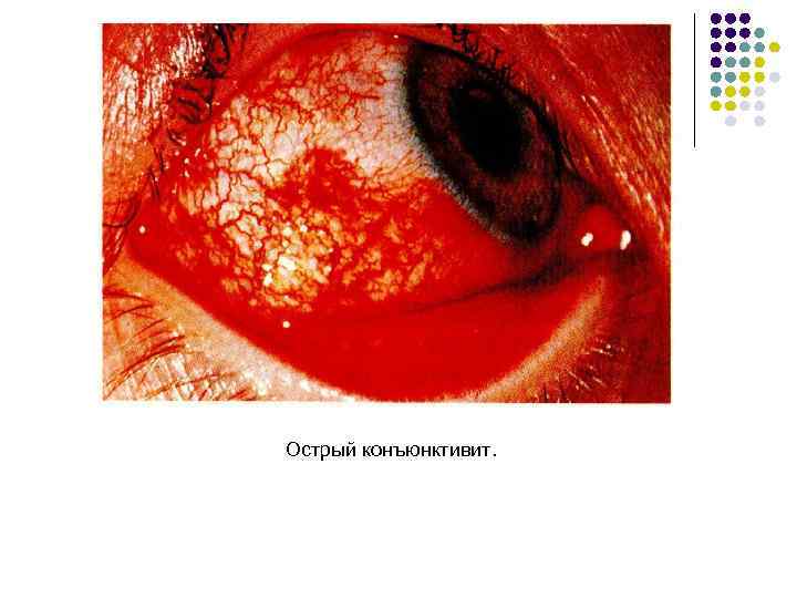 Острый конъюнктивит. 
