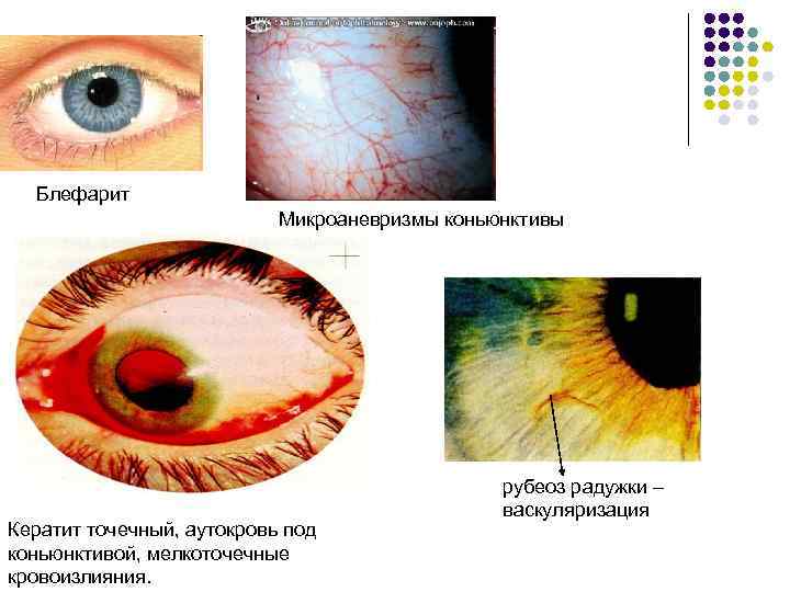 Блефарит Микроаневризмы коньюнктивы Кератит точечный, аутокровь под коньюнктивой, мелкоточечные кровоизлияния. рубеоз радужки – васкуляризация