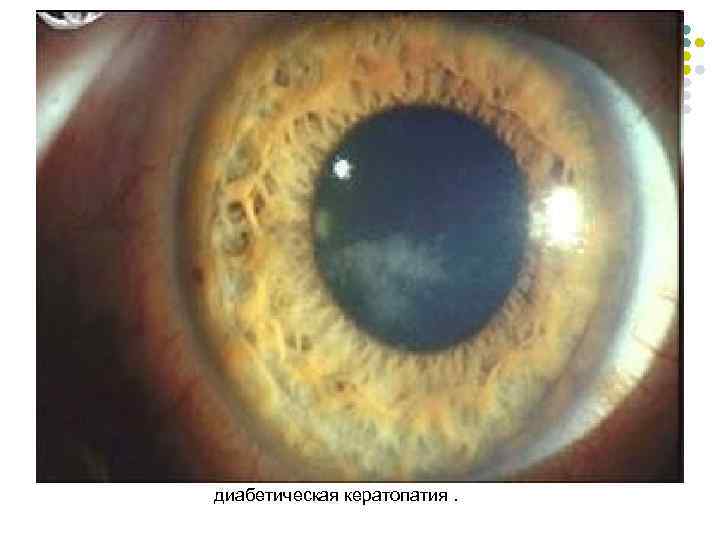 диабетическая кератопатия. 