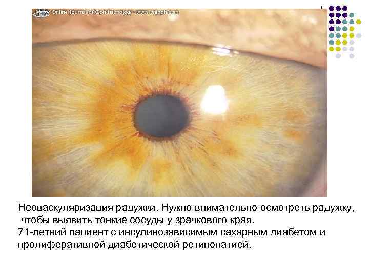 Неоваскуляризация радужки. Нужно внимательно осмотреть радужку, чтобы выявить тонкие сосуды у зрачкового края. 71