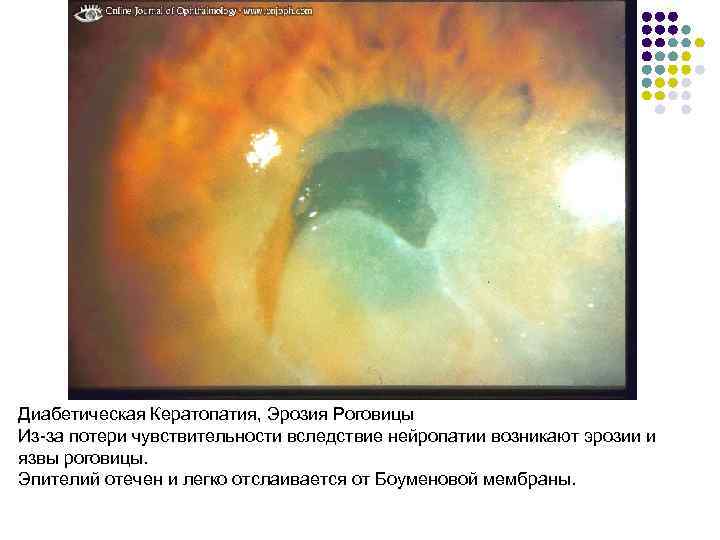 Диабетическая Кератопатия, Эрозия Роговицы Из-за потери чувствительности вследствие нейропатии возникают эрозии и язвы роговицы.
