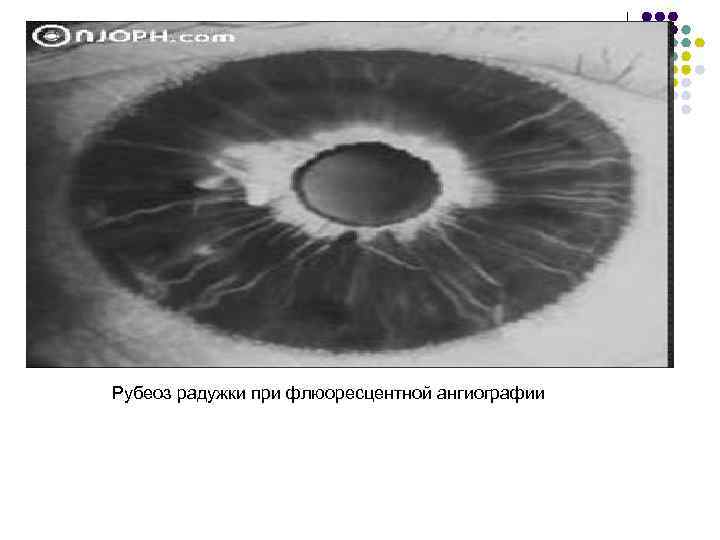 Рубеоз радужки при флюоресцентной ангиографии 