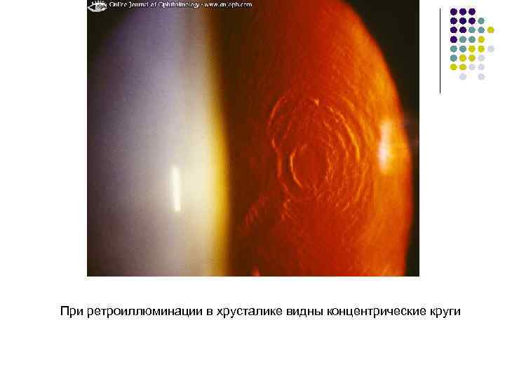 При ретроиллюминации в хрусталике видны концентрические круги 