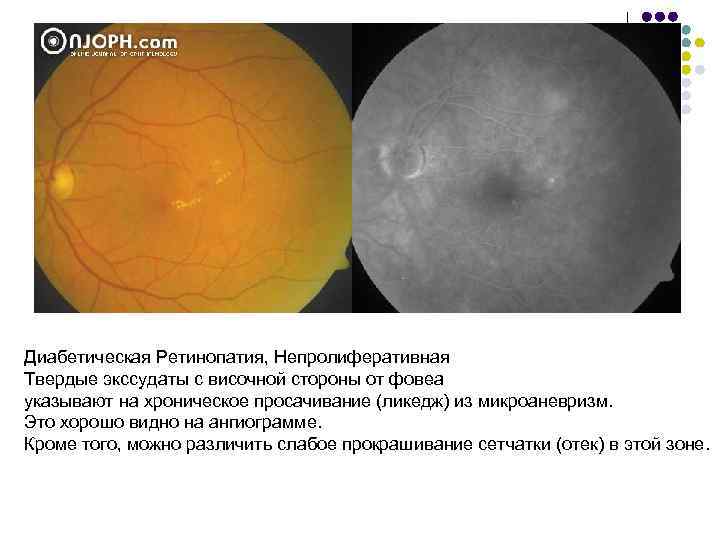 Диабетическая Ретинопатия, Непролиферативная Твердые экссудаты с височной стороны от фовеа указывают на хроническое просачивание