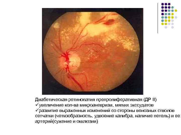 Диабетическая ретинопатия препролиферативная (ДР II) üувеличение кол-ва микроаневризм, мягких экссудатов üразвитие выраженных изменений со