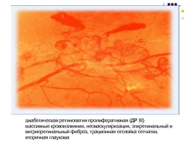 диабетическая ретинопатия пролиферативная (ДР III) массивные кровоизлияния, неоваскуляризация, эпиретинальный и витриоретинальный фиброз, трационная отслойка