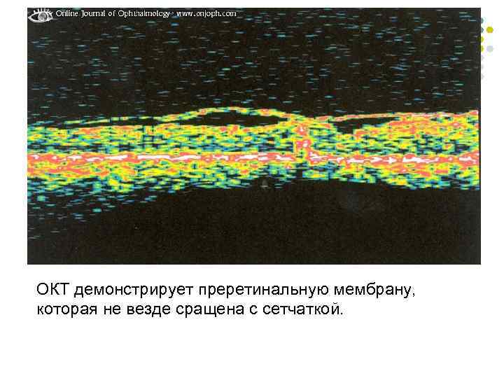 ОКТ демонстрирует преретинальную мембрану, которая не везде сращена с сетчаткой. 