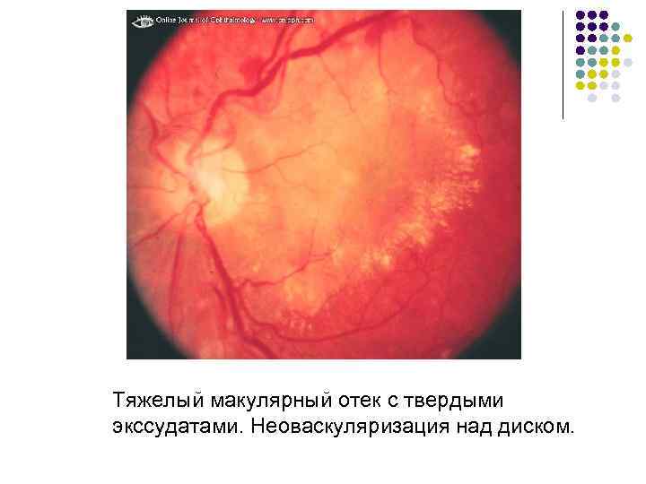 Тяжелый макулярный отек с твердыми экссудатами. Неоваскуляризация над диском. 
