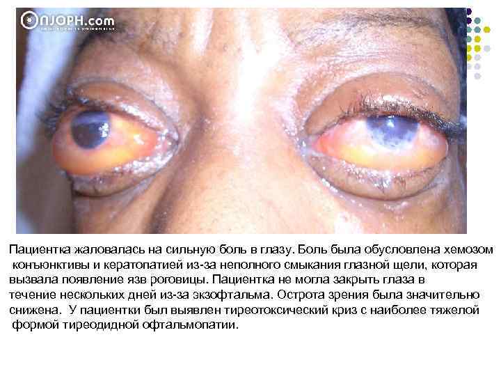 Пациентка жаловалась на сильную боль в глазу. Боль была обусловлена хемозом конъюнктивы и кератопатией