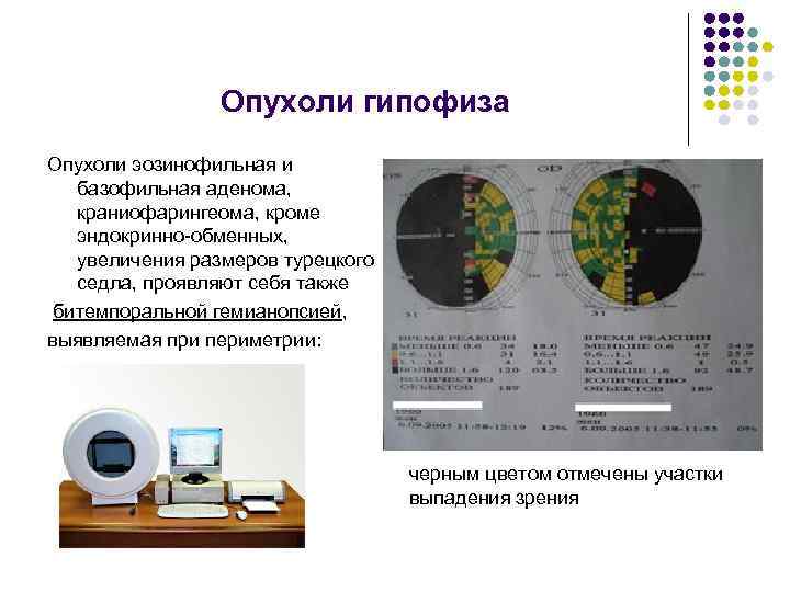 Опухоли гипофиза Опухоли эозинофильная и базофильная аденома, краниофарингеома, кроме эндокринно-обменных, увеличения размеров турецкого седла,