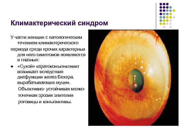 Климактерический синдром У части женщин с патологическим течением климактерического периода среди прочих характерных для