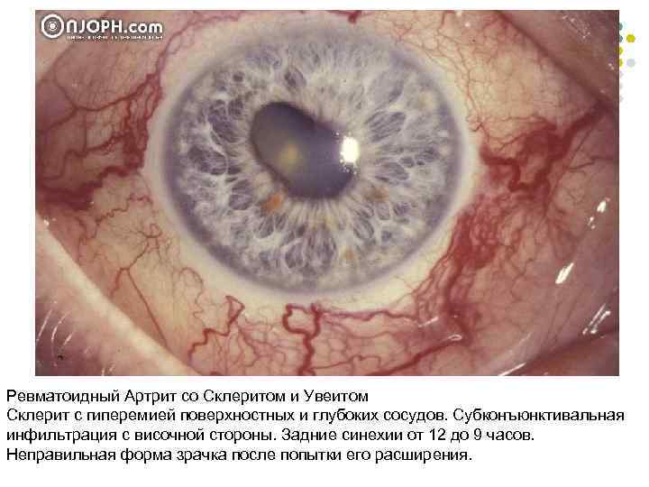 Ревматоидный Артрит со Склеритом и Увеитом Склерит с гиперемией поверхностных и глубоких сосудов. Субконъюнктивальная
