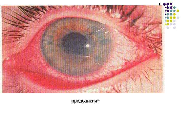 иридоциклит 