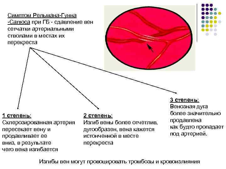 Симптом Рельмана-Гунна -Салюса при ГБ - сдавление вен сетчатки артериальными стволами в местах их