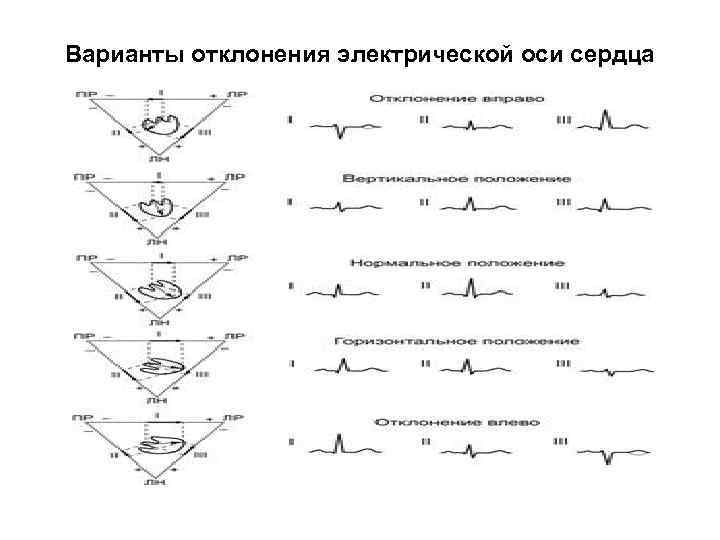 Отклонение электрической оси. Варианты электрической оси. Отклонение электрической оси сердца. Отклонение ЭОС варианты. Электрическая ось критерии.