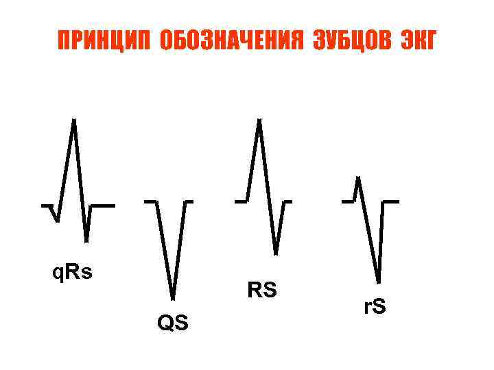 ПРИНЦИП ОБОЗНАЧЕНИЯ ЗУБЦОВ ЭКГ q. Rs RS QS r. S 