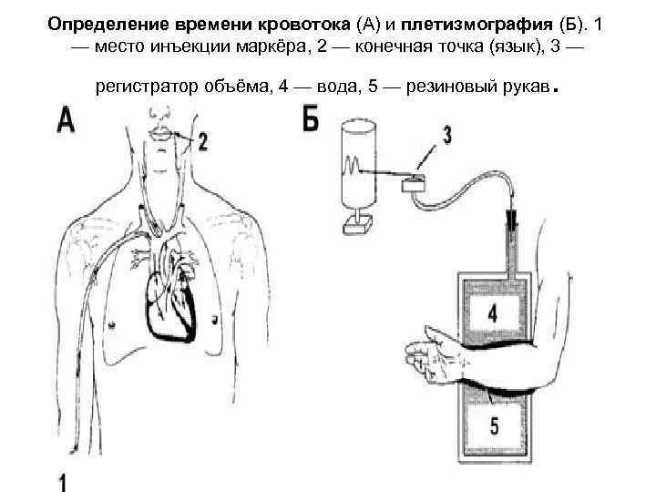 Определение времени кровотока (А) и плетизмография (Б). 1 — место инъекции маркёра, 2 —