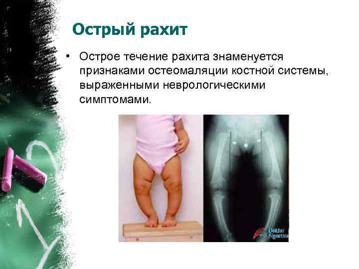  Острый рахит • Острое течение рахита знаменуется признаками остеомаляции костной системы, выраженными неврологическими