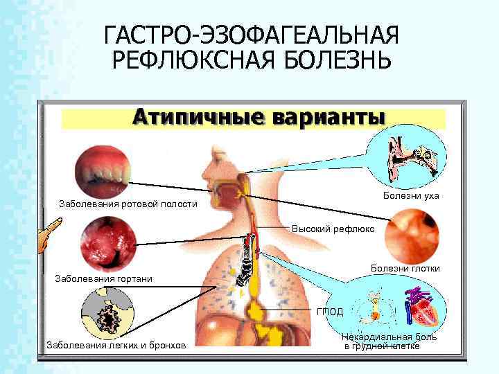 ГАСТРО-ЭЗОФАГЕАЛЬНАЯ РЕФЛЮКСНАЯ БОЛЕЗНЬ Болезни уха Заболевания ротовой полости Высокий рефлюкс Болезни глотки Заболевания гортани