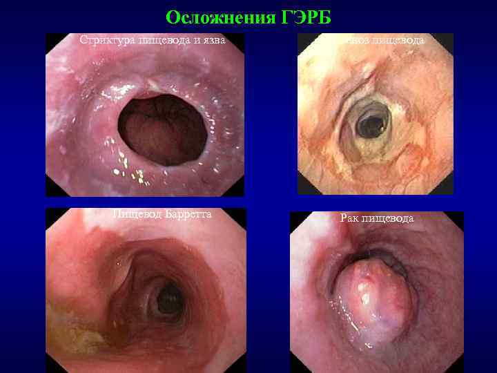 Осложнения ГЭРБ Стриктура пищевода и язва Пищевод Барретта Стеноз пищевода Рак пищевода 