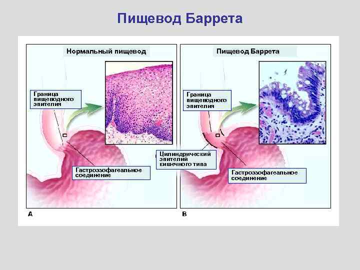 Пищевод Баррета Нормальный пищевод Граница пищеводного эпителия Пищевод Баррета Граница пищеводного эпителия Гастроэзофагеальное соединение