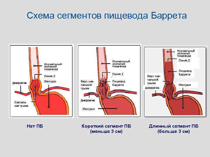 Схема сегментов пищевода Баррета Нормальный эпителий пищевода Линия Z Желудок Диафрагма Хиатальная грыжа Нет