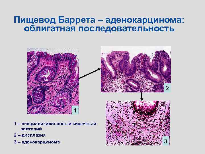 Пищевод Баррета – аденокарцинома: облигатная последовательность 2 1 1 – специализированный кишечный эпителий 2