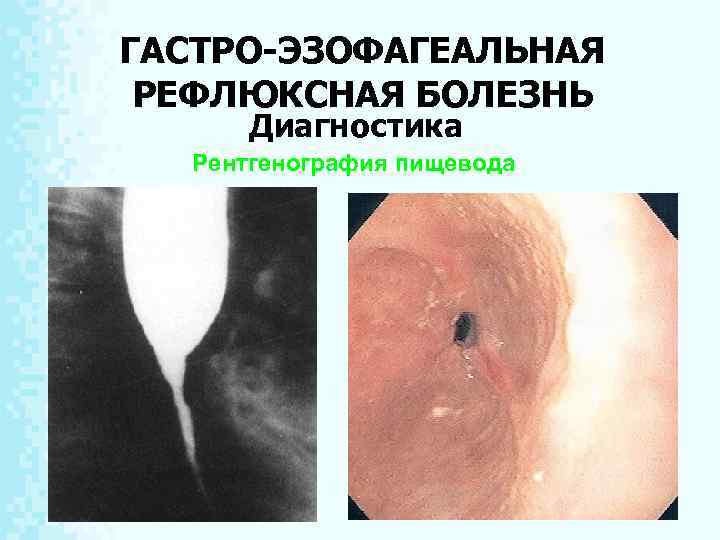 ГАСТРО-ЭЗОФАГЕАЛЬНАЯ РЕФЛЮКСНАЯ БОЛЕЗНЬ Диагностика Рентгенография пищевода 8 