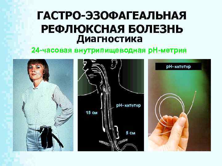 ГАСТРО-ЭЗОФАГЕАЛЬНАЯ РЕФЛЮКСНАЯ БОЛЕЗНЬ Диагностика 24 -часовая внутрипищеводная р. Н-метрия р. Н- катетер 15 см