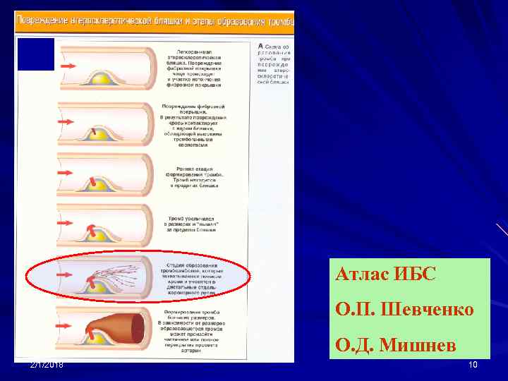 Атлас ИБС О. П. Шевченко О. Д. Мишнев 2/1/2018 10 