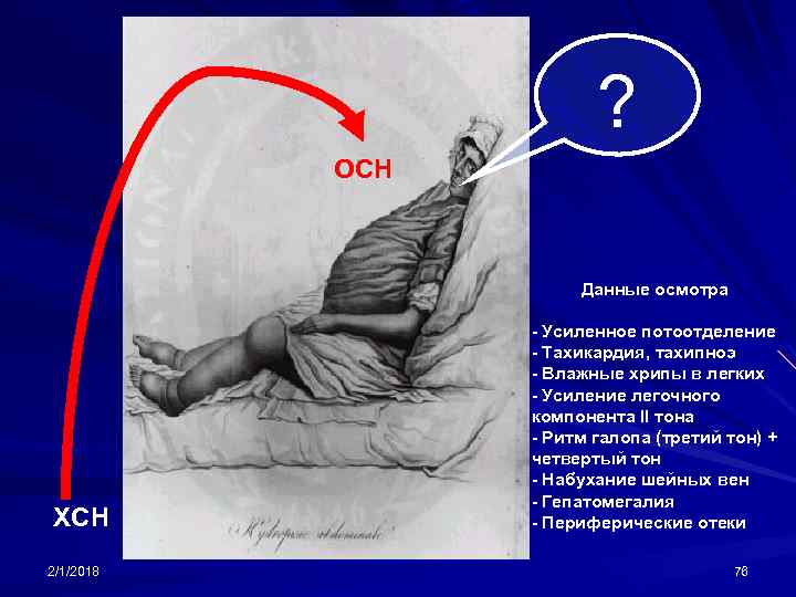 ? ОСН Данные осмотра ХСН 2/1/2018 - Усиленное потоотделение - Тахикардия, тахипноэ - Влажные