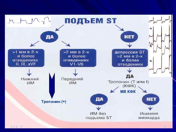 МВ КФК Тропонин (+) 2/1/2018 78 