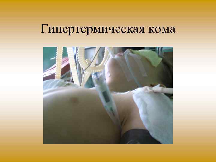 Гипертермическая кома 