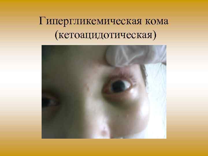 Гипергликемическая кома (кетоацидотическая) 