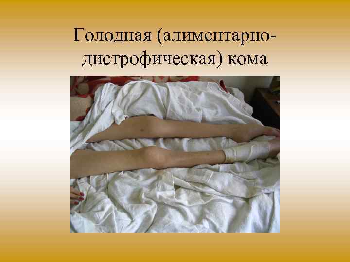 Голодная (алиментарно дистрофическая) кома 
