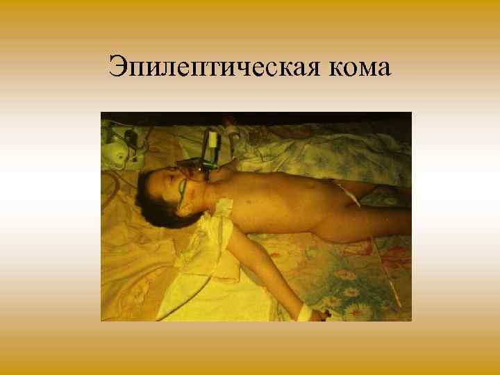 Эпилептическая кома 