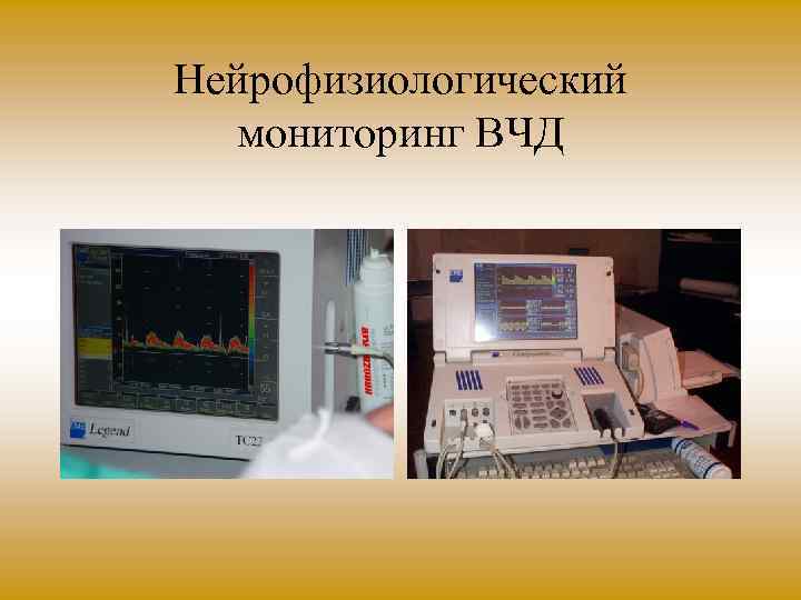 Нейрофизиологический мониторинг ВЧД 