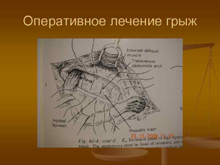 Оперативное лечение грыж 