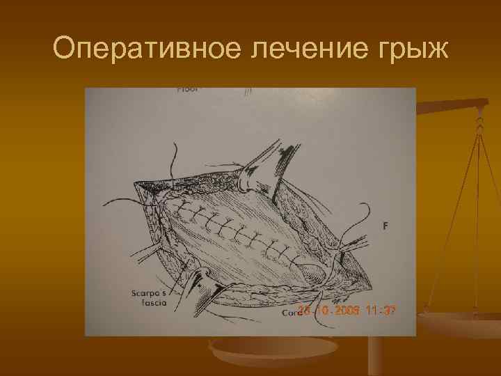 Оперативное лечение грыж 