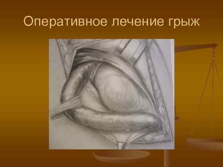 Оперативное лечение грыж 