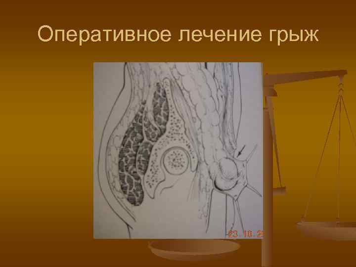 Оперативное лечение грыж 