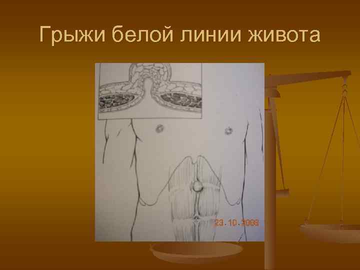 Грыжи белой линии живота 