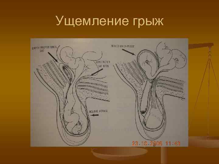 Ущемление грыжи. Ущемление полового члена. Ущемленная грыжа живота. Диагностика ущемленной грыжи.